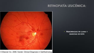 • HEMORRAGIAS EN LLAMA Y
MANCHAS DE ROTH
RETINOPATÍA LEUCÉMICA:
 