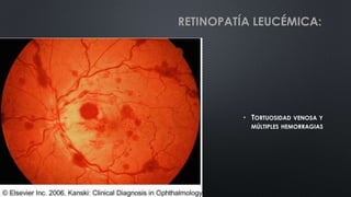 • TORTUOSIDAD VENOSA Y
MÚLTIPLES HEMORRAGIAS
RETINOPATÍA LEUCÉMICA:
 