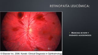 • MANCHAS DE ROTH Y
EXUDADOS ALGODONOSOS
RETINOPATÍA LEUCÉMICA:
 