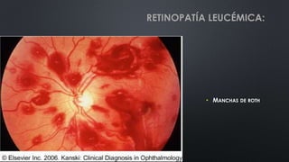 • MANCHAS DE ROTH
RETINOPATÍA LEUCÉMICA:
 