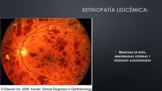 • MANCHAS DE ROTH,
HEMORRAGIAS EXTENSAS Y
EXUDADOS ALGODONOSOS
RETINOPATÍA LEUCÉMICA:
 