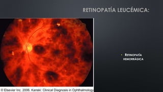 • RETINOPATÍA
HEMORRÁGICA
RETINOPATÍA LEUCÉMICA:
 