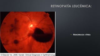 • HEMORRAGIA VÍTREA
RETINOPATÍA LEUCÉMICA:
 