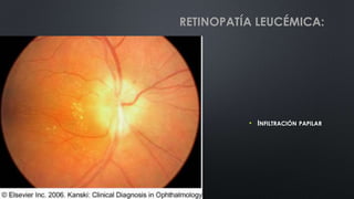 • INFILTRACIÓN PAPILAR
RETINOPATÍA LEUCÉMICA:
 