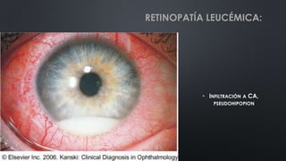 • INFILTRACIÓN A CA,
PSEUDOHIPOPION
RETINOPATÍA LEUCÉMICA:
 