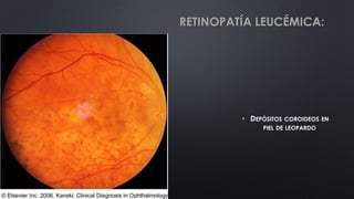 • DEPÓSITOS COROIDEOS EN
PIEL DE LEOPARDO
RETINOPATÍA LEUCÉMICA:
 