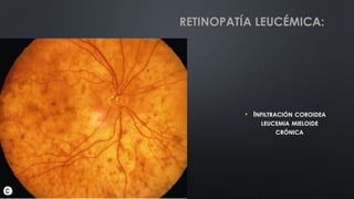 • INFILTRACIÓN COROIDEA
LEUCEMIA MIELOIDE
CRÓNICA
RETINOPATÍA LEUCÉMICA:
 