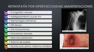 • Congestión venosa.
• Adelgazamiento cruces AV.
• Hemorragias retinianas.
• DR Seroso.
• Microaneurismas.
• Oclusiones venosas.
• Neovascularización.
• Edema de papila.
• Quistes pars plana: Mieloma Múltiple.
RETINOPATÍA POR HIPERVISCOSIDAD: MANIFESTACIONES
 