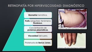 Biometría hemática.
Frotis sanguíneo: fenómeno
Rouleaux.
Concentración de
proteínas plasmáticas.
Viscosidad del suero.
Proteinuria de Bence Jones.
RETINOPATÍA POR HIPERVISCOSIDAD: DIAGNÓSTICO
 