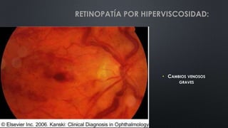 • CAMBIOS VENOSOS
GRAVES
RETINOPATÍA POR HIPERVISCOSIDAD:
 