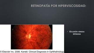 • OCLUSIÓN VENOSA
RETINIANA
RETINOPATÍA POR HIPERVISCOSIDAD:
 