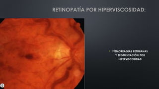 • HEMORRAGIAS RETINIANAS
Y SEGMENTACIÓN POR
HIPERVISCOSIDAD
RETINOPATÍA POR HIPERVISCOSIDAD:
 