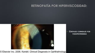 • CRISTALES CORNEALES POR
PARAPROTEINEMIA
RETINOPATÍA POR HIPERVISCOSIDAD:
 