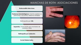MANCHAS DE ROTH: ASOCIACIONES
Endocarditis infecciosa.
Trastornos hematológicos: Anemia aplásica o
perniciosa, Leucemia, Mieloma Múltiple.
Retinopatía por VIH.
Isquemia, intoxicación por monóxido de
carbono, DM2.
Retinopatía por radiación.
Sx de Shaken baby.
 