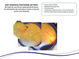 Retinopatia de la prematuridad.ppt