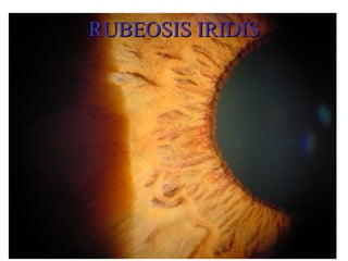 Retinopatia diabetica | PPT