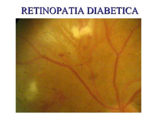 Retinopatia diabetica Retinopatia diabetica