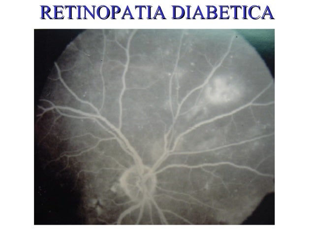 Retinopatia diabetica Retinopatia diabetica