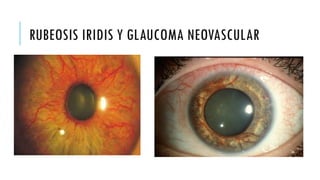 RETINOPATIA DIABETICA.pptxhhhhhhhhhuuuui | PPTX