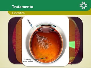 Tratamento
Específico
 Fotocoagulação Pan-Retiniana (FPR)





Indicações: RDP
1200-2000 disparos extramaculares
Reduzir área isquêmica (↓VEGF e IGF-1)
↓risco cegueira em 95%

 Laser focal
 Indicação: EMCS
 Disparos parafoveais

 Anti-VEGF
 antiangiogênicos biológicos
 Injeção intra-vítrea
 Avastin (bevacizumab), Lucentis (ranibizumab)

 