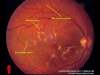 Hemorragia

Exsudato duro

Microaneurisma

 