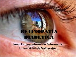 RETINOPATÍA
     DIABÉTICA
Jenni Urbina interna de Enfermería
    Universidad de Valparaíso
 
