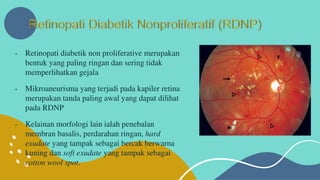 Retinopati diabetik