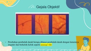 Retinopati diabetik