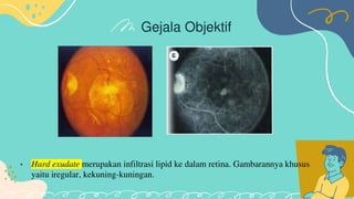 Retinopati diabetik