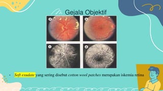 Retinopati diabetik
