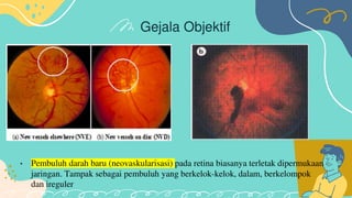 Retinopati diabetik