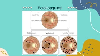 Retinopati diabetik