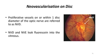 Nvd Optometry Diabetic Retinopathy | PPTX