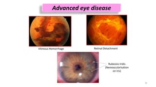 Diabetic Retinopathy | PPTX