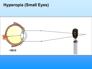 Hyperopia (Small Eyes)




  +58 D
 