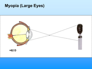 Myopia (Large Eyes)




  +62 D
 