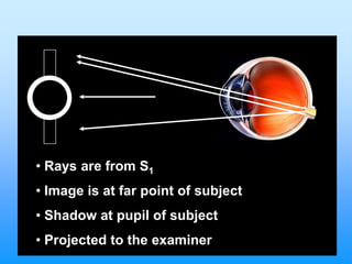 • Rays are from S1
• Image is at far point of subject
• Shadow at pupil of subject
• Projected to the examiner
 
