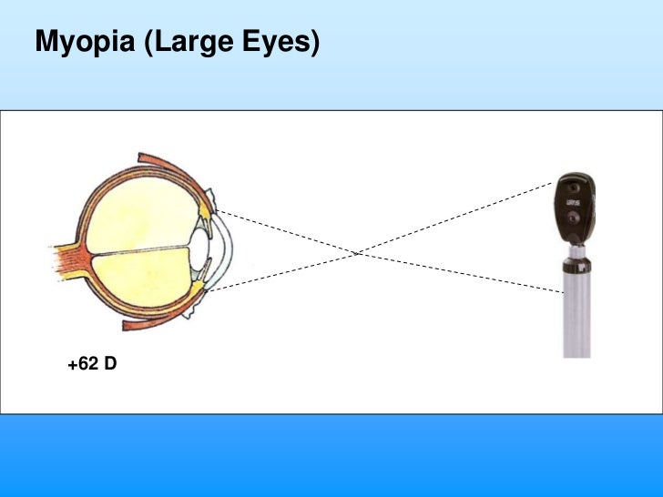 Refraction and Retinoscopy