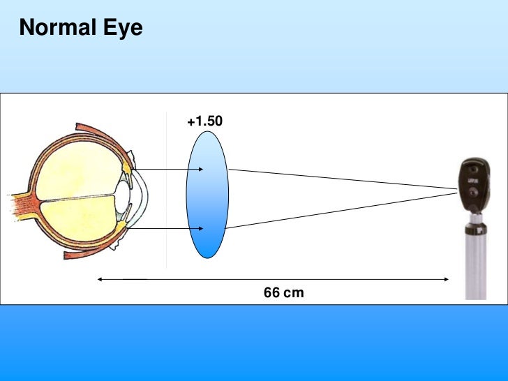 Refraction and Retinoscopy