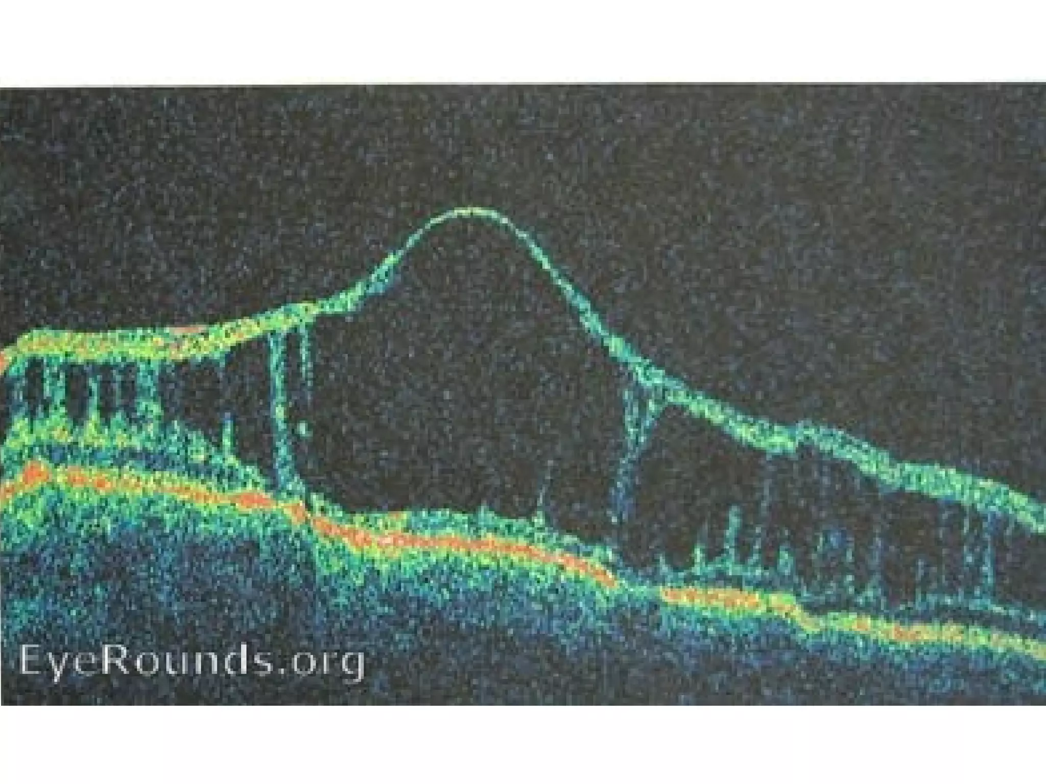Retinoschisis | PPT