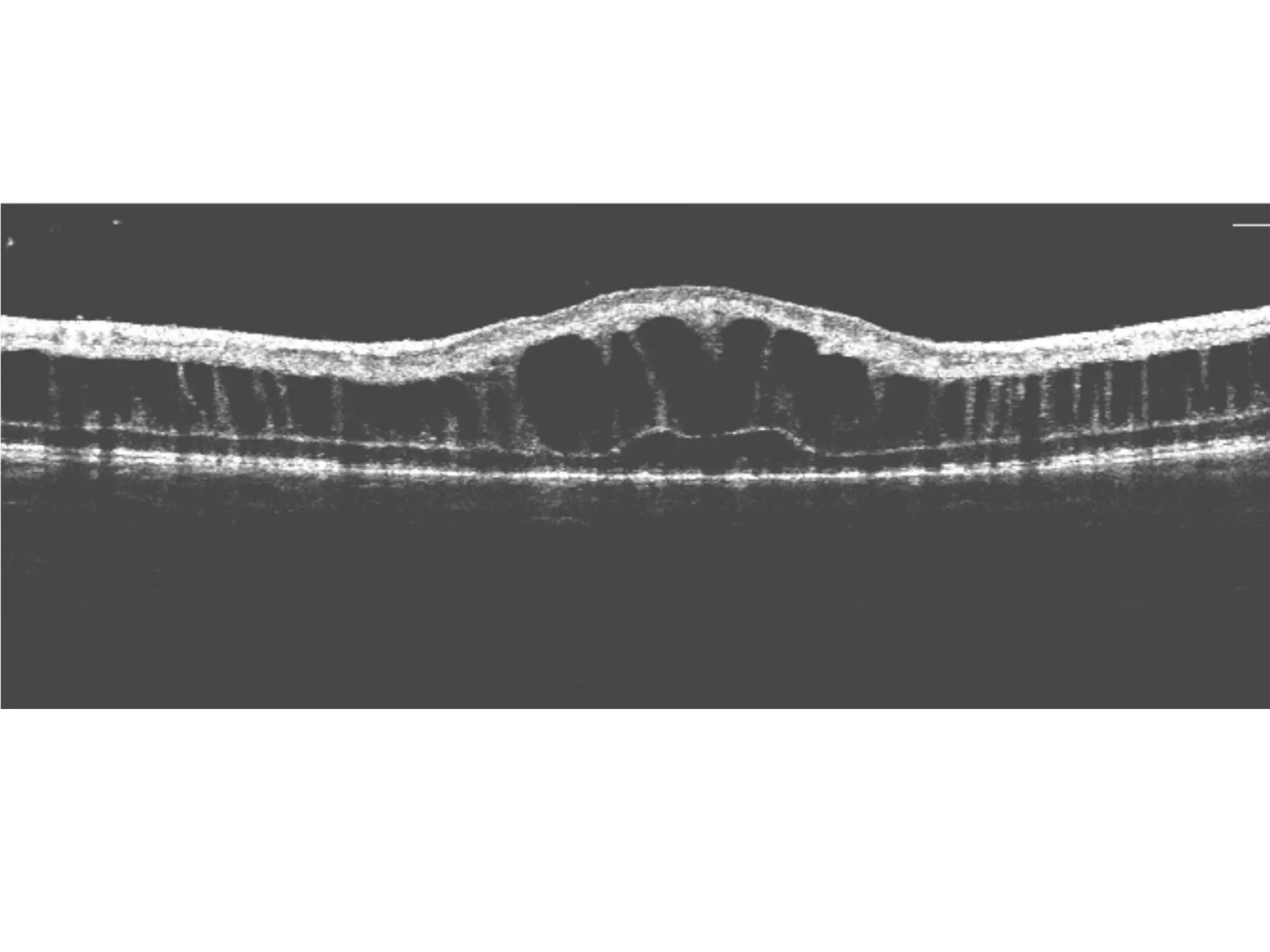 Retinoschisis | PPT