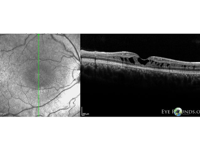Retinoschisis | PPT