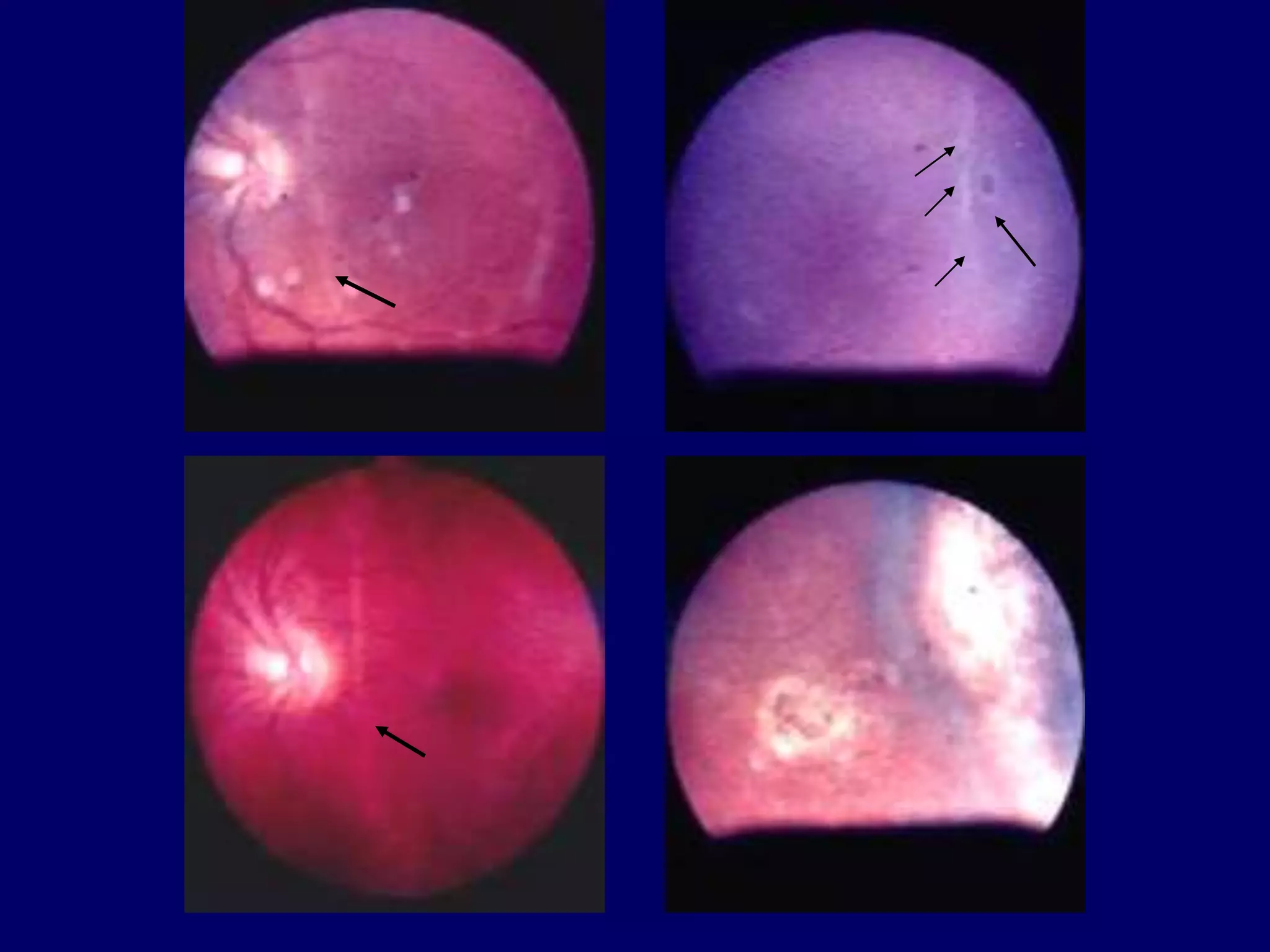 RETINOSCHISIS AND RETINAL DETACHMENT | PPT