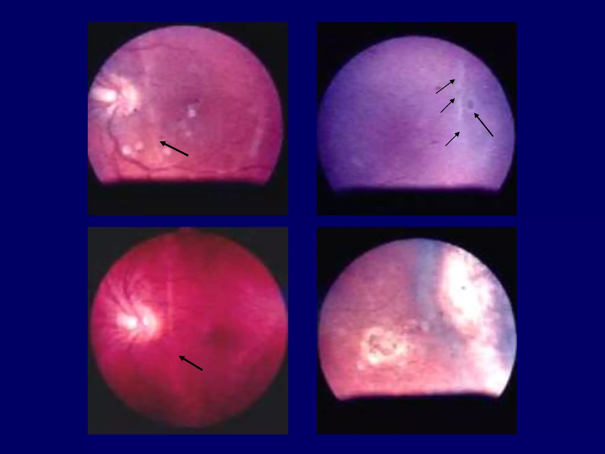 RETINOSCHISIS AND RETINAL DETACHMENT | PPT