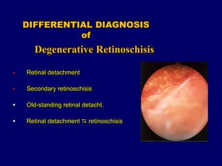 RETINOSCHISIS AND RETINAL DETACHMENT | PPT