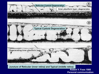 RETINOSCHISIS AND RETINAL DETACHMENT | PPT