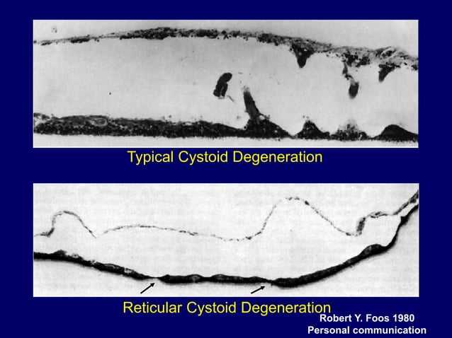 RETINOSCHISIS AND RETINAL DETACHMENT | PPT | Eye and Vision Conditions ...