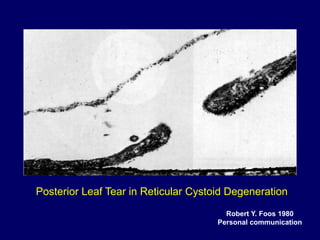 RETINOSCHISIS AND RETINAL DETACHMENT | PPT