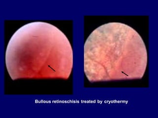 RETINOSCHISIS AND RETINAL DETACHMENT | PPT