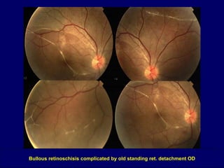 RETINOSCHISIS AND RETINAL DETACHMENT | PPT